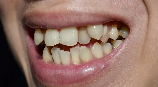 Understanding Malocclusion: What It Is and How Orthodontics Can Help
